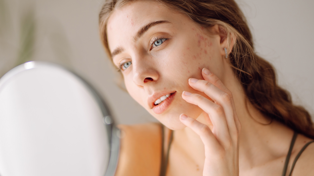 Astaxanthin for Acne-Prone Skin:Clearing Breakouts While Calming Redness